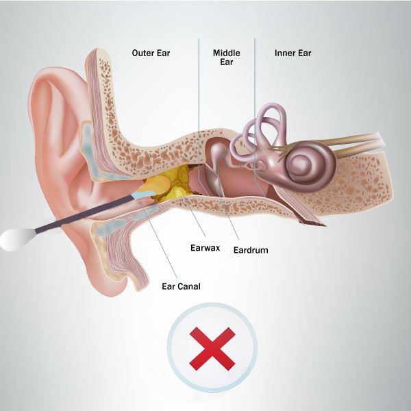 Diagram showing why cotton swabs are bad for your ears.